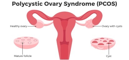 PCOS and Diet culture Ottawa | The Balanced Practice
